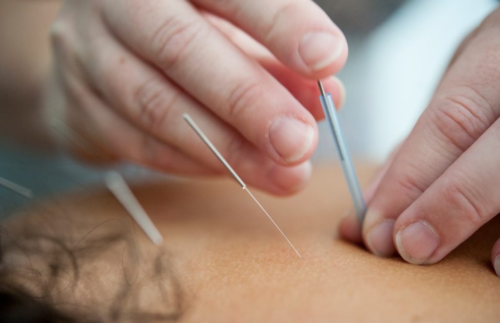 acupuncture-needles-inserted-into-skin-qgcdtm9ra5s