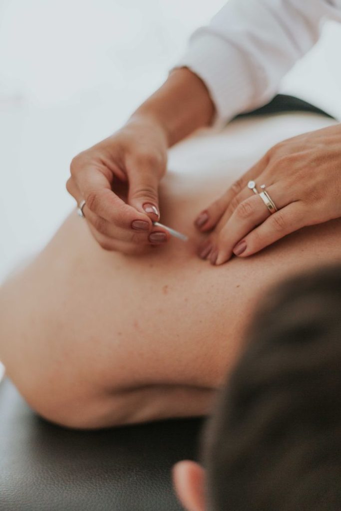 Close-up of a therapist performing acupuncture on a persons back in a calming environment.